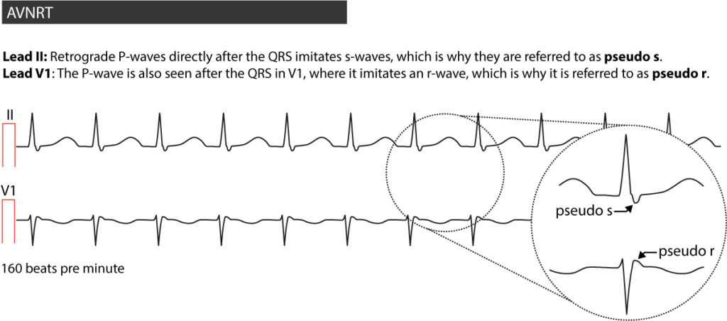 Atrioventricular Nodal Reentry Tachycardia AVNRT ECG Features 