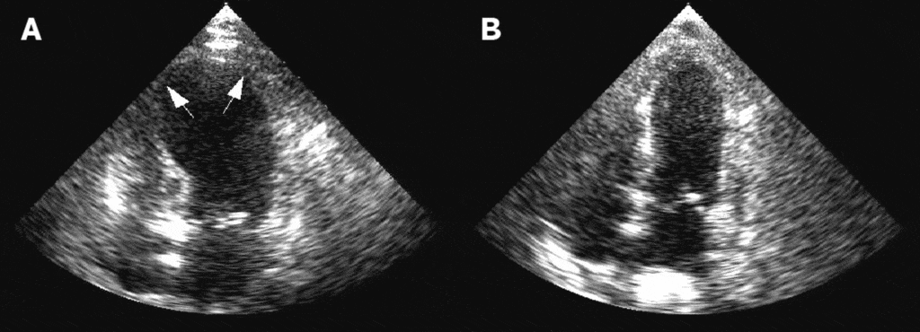 Figure 1. Echocardiogram showing takotsubo cardiomyopathy in acute phase (A) and resolution phase (B). Note the apical ballooning of the apical portion fo the left ventricle (A).