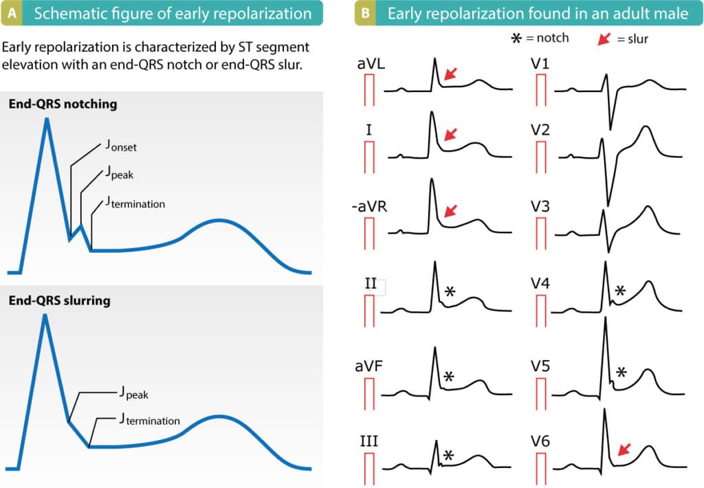 Figure 5. Early repolarization (after MacFarlane et al, 2016, Eur Hear J).