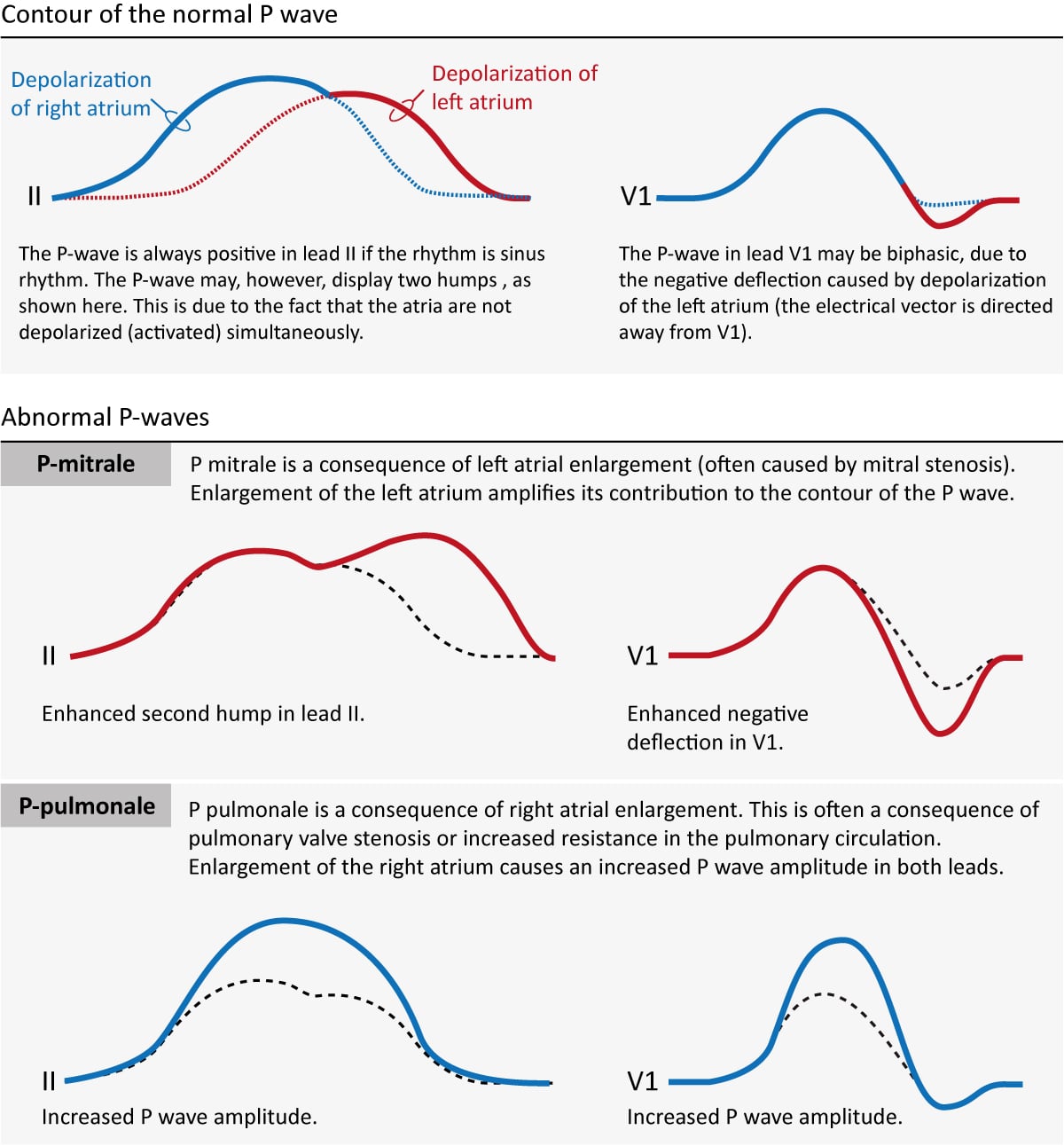 left-atrial-enlargement-ecg-p-mitrale-right-atrial-enlargement-ecg