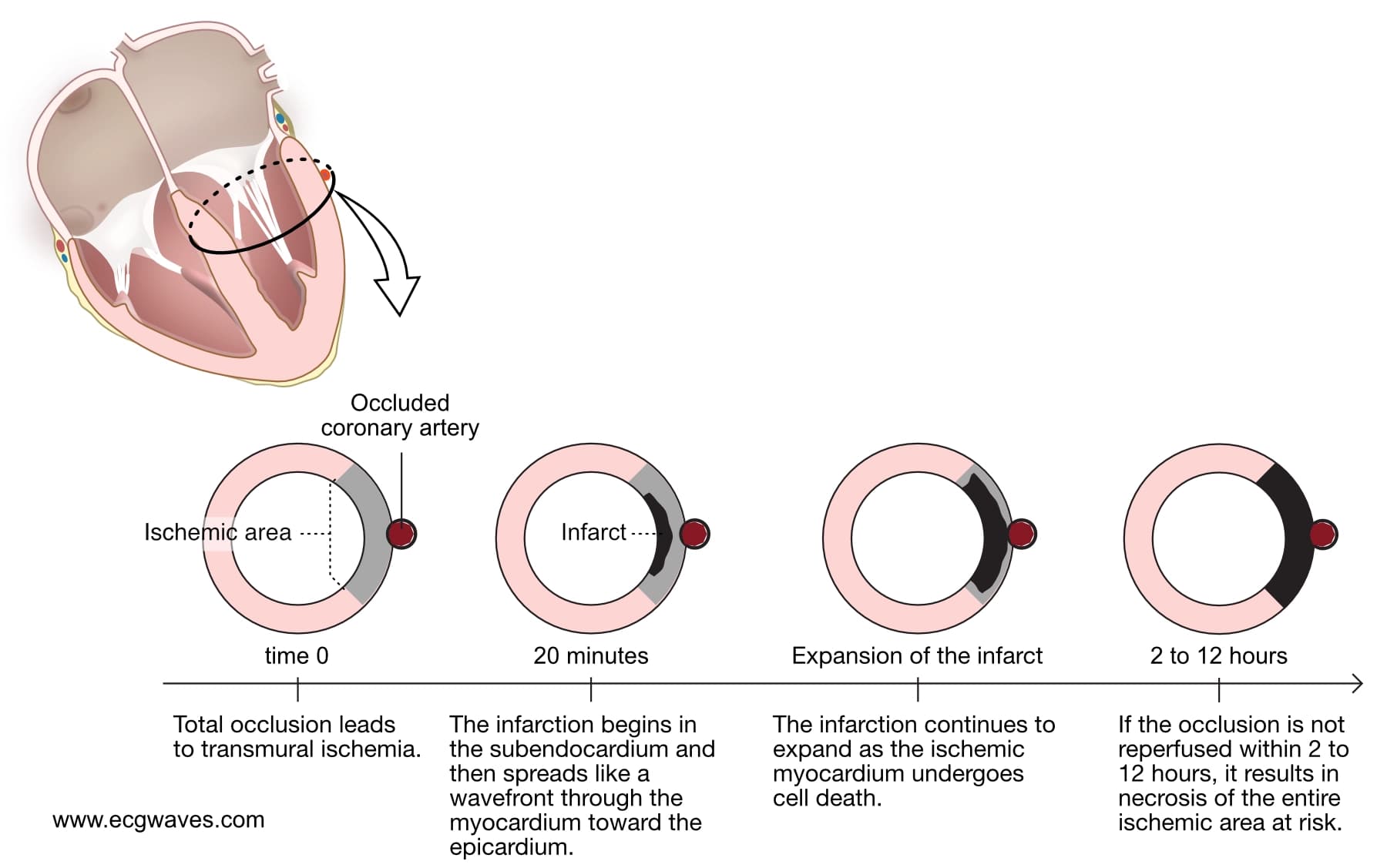 acute myocardial infarction ischemia ECG st changes elevation depression