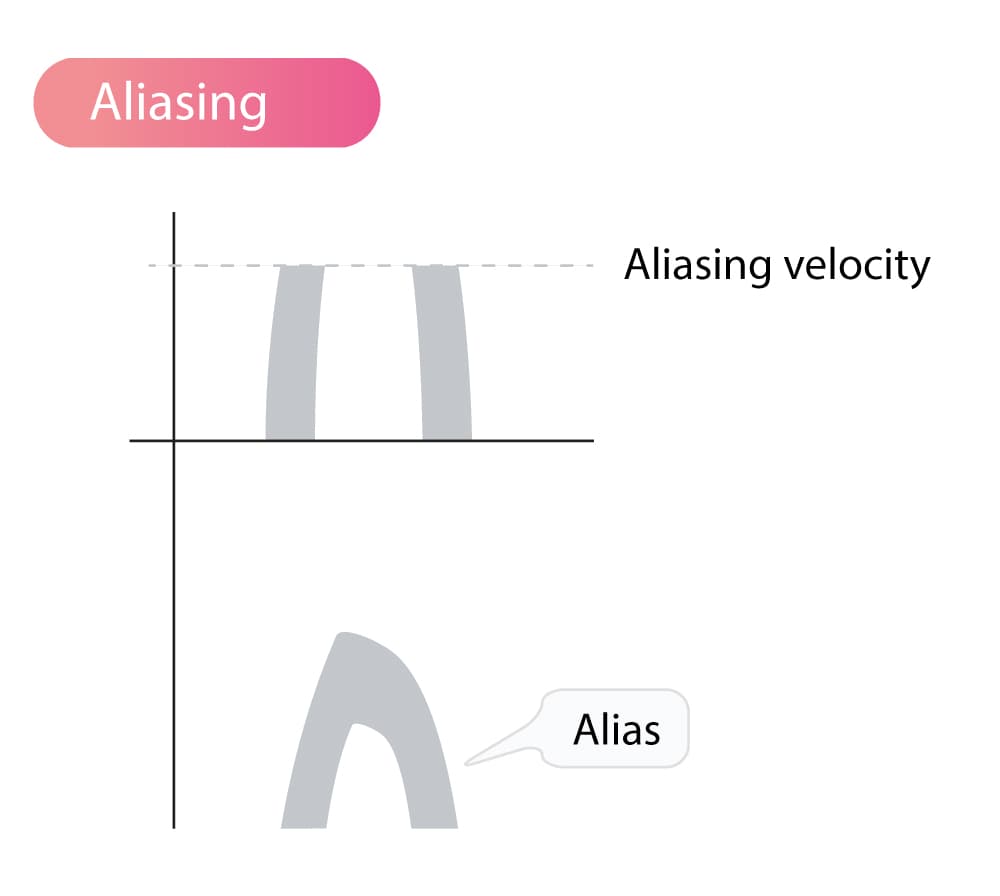 aliasing phenomenon speed ultrasound echocardiography