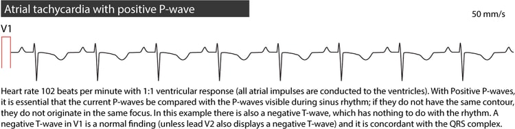 Figure 3. Atrial tachycardia.