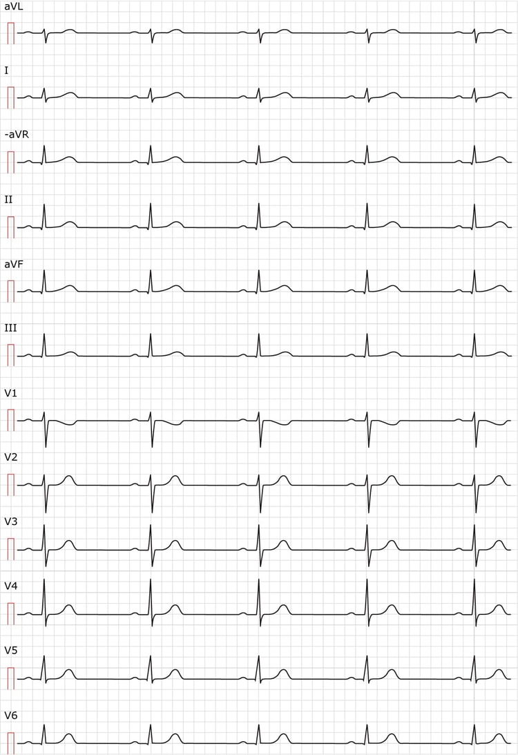 Figure 2. Sinus rhythm. Paper speed 50 mm/s.