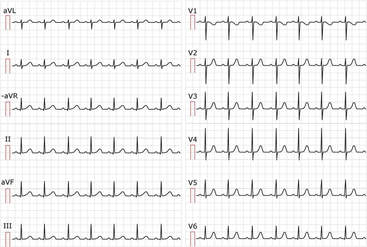 Figure 1. ECG showing sinus tachycardia. Paper speed 25 mm/s. Calculate the heart rate by dividing 300 by the number of large boxes between R-waves. There are approximately 3 large boxes between the R-waves; 300/3 equals 100 beats per minute.