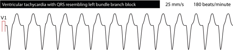 Figure 5. Ventricular tachycardia with left bundle branch block morphology.