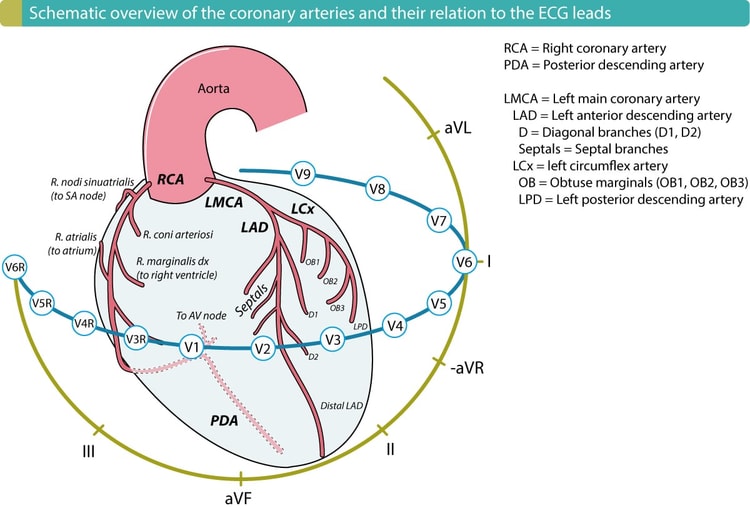 The right ventricle is supplied by the right marginal artery (r. marginalis dx), which originates from the right coronary artery (RCA). The RCA also supplies the inferior left ventricular wall in over 90% of all individuals. Hence, a proximal occlusion (in the RCA) which cuts off blood flow to the right ventricle, will also affect the inferior wall of the left ventricle in 90% of the cases.