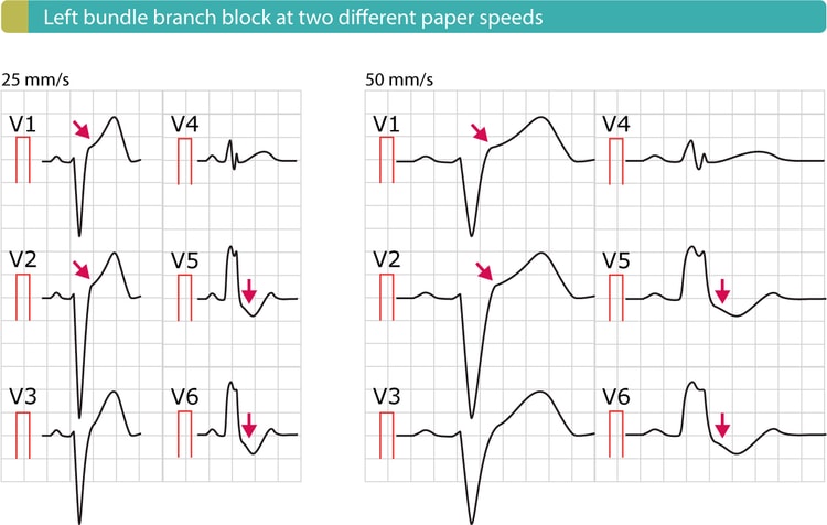 Figure 4. Left bundle branch block (LBBB) with typical ST elevations (V1–V2) and ST depressions (V5-V6).