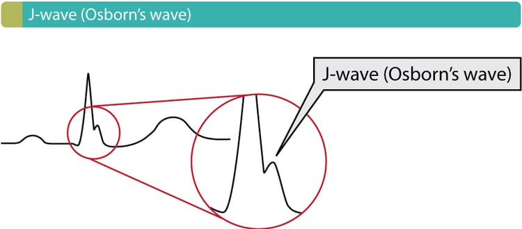 Figure 1. Osborn wave (J wave). These waves occur due to hypothermia, hypercalcemia, early repolarization and Brugada syndrome.