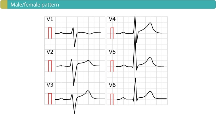Figure 4. Male/female pattern. Also called "normal ST segment elevation".