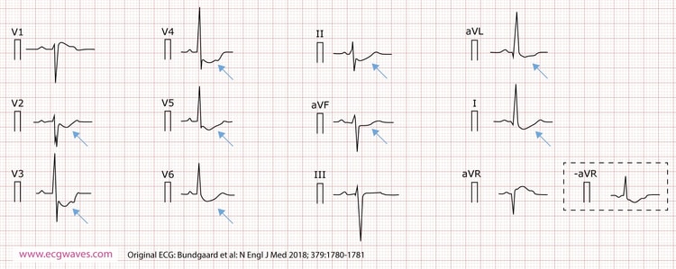 Figure 4. 12-lead ECG (presented according to Cabrera), recorded at 63 years of age, demonstrates concave-upward ST-segment depression in leads I, II, aVL, aVF, and V2 through V6; and ST-segment elevation in lead aVR (which corresponds to an identical ST-segment depression in the inverted lead -aVR). A notch is evident in the ascending part of the ST segment.