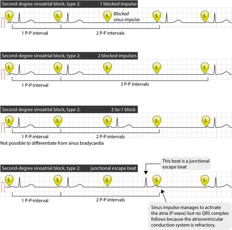 Figure 3. Several cases of type 2 second-degree sinoatrial block.