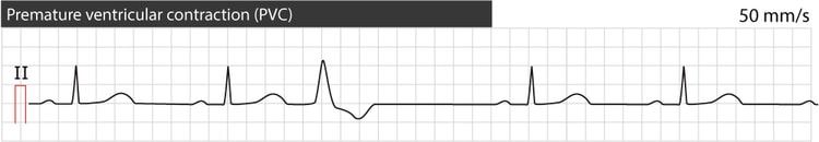 Figure 1. Premature ventricular contraction (complex/beat). Typical appearance. Note the paper speed 50 mm/s (1 large box equals 100 ms).