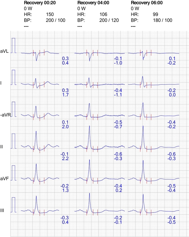 Figure 8. ECG reaction in limb leads during recovery.