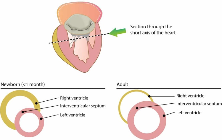 Figure 1. Cross-sectional view of ventricular wall thickness in children (<1 months old) and adults.