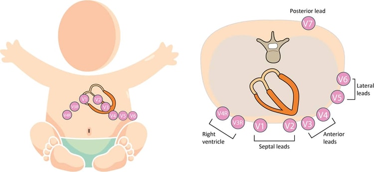 Figure 2. Placement of chest leads in children