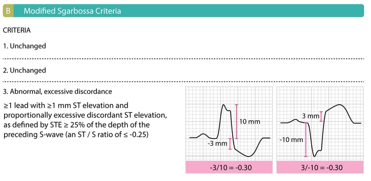 Figure 1B: Criteria 1 and 2 of the original Sgarbossa criteria are unchanged. The R or S wave, whichever is most prominent, and ST segments (relative to the PR segment), is measured to the nearest 0.5 mm. The ST/S ratio is calculated for each lead that has both discordant ST deviation ≥1 mm.