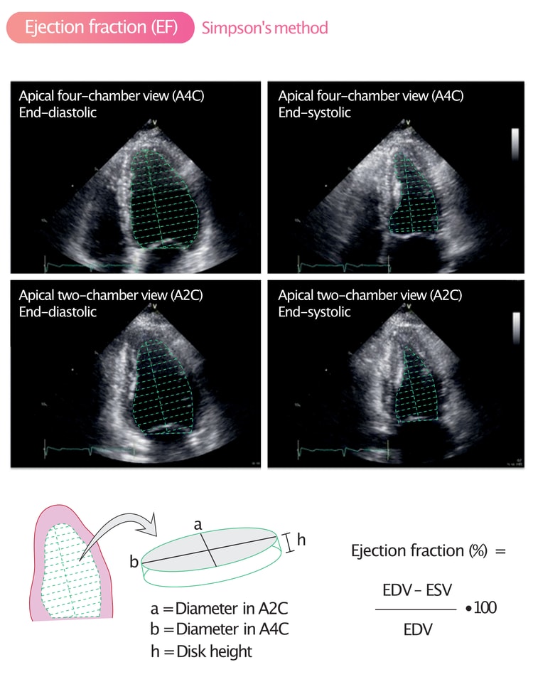 Figure 3. Calculation of ejection fraction (EF) using Simpson