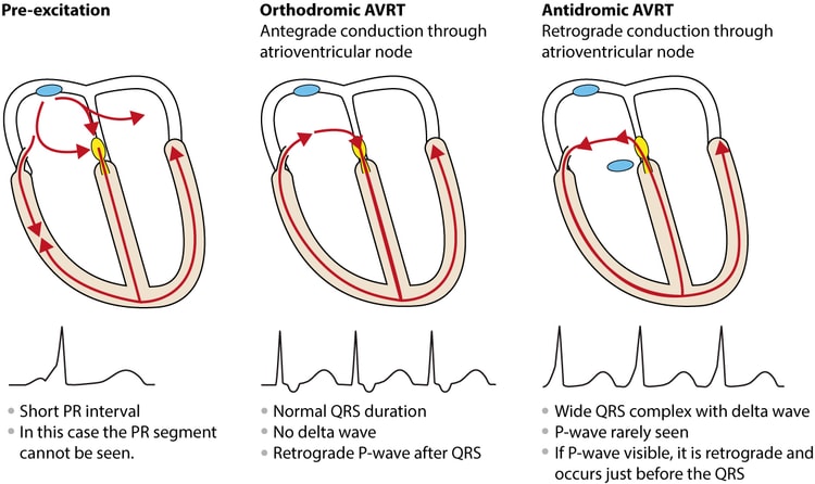 Figure 3. Antidromic and orthdromic AVRT.