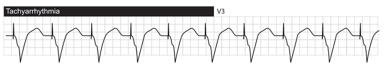 Tachyarrhythmia with ventricular pacing.