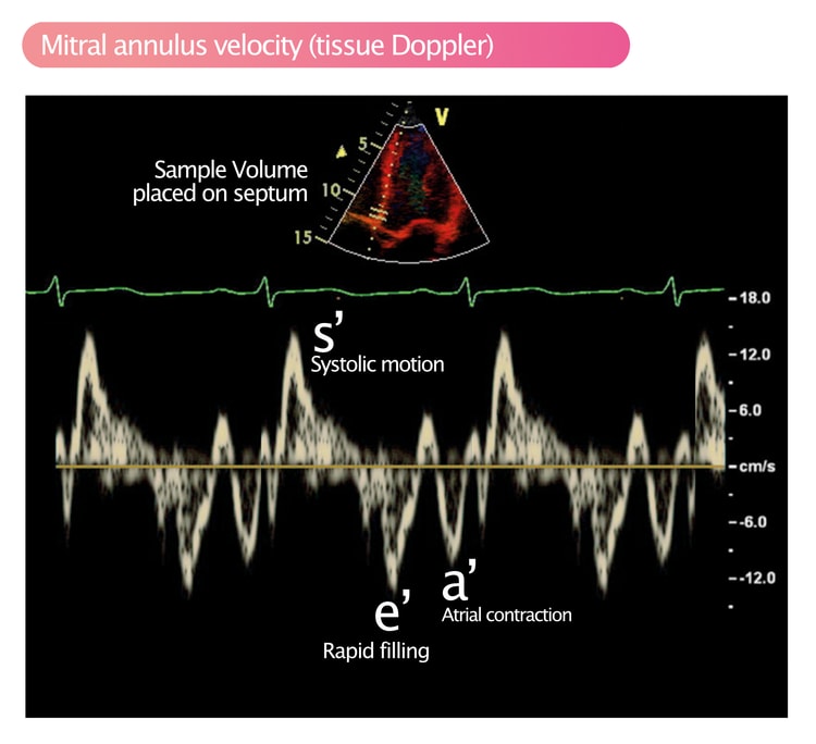Figure 2. Tissue Doppler analyzing motions of the mitral annulus.