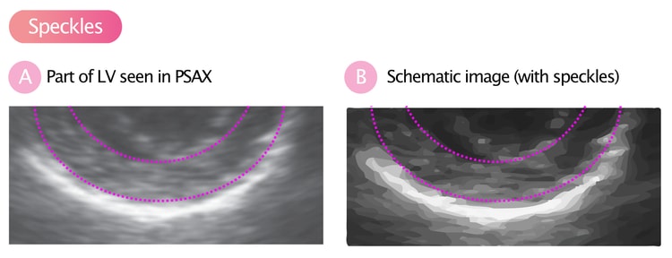 Figure 8. (A) The myocardium has been encircled within the dashed lines. As seen here, the myocardium is not homogeneous on the ultrasound image. It appears structureds. These structures are called speckles” (B) The same image with speckles highlighted.