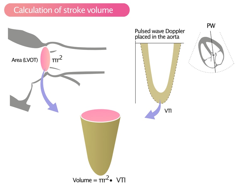Figure 1. Calculation of stroke volume in LVOT.