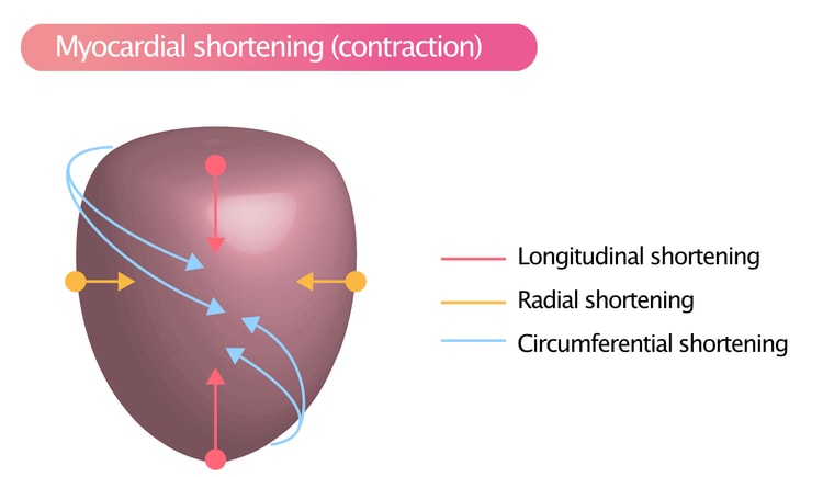 Figure 3. Myocardial contraction (shortening) occurs in three directions: longitudinally, radially and circumferentially.