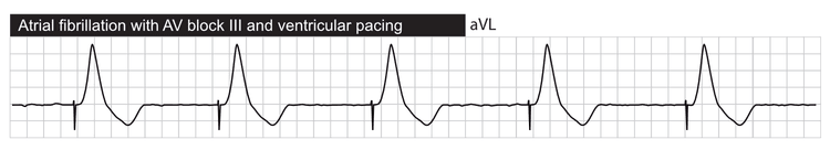 Atrial fibrillation with third-degree AV block, with ventricular pacing.
