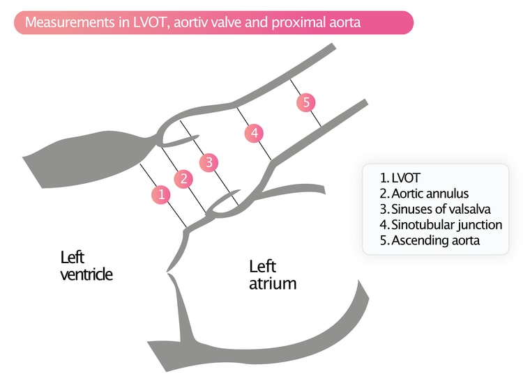 Figure 5. Measurements in LVOT, aortiv valve and proximal aorta.