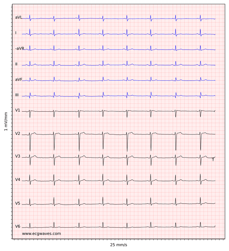 Figure 3. Sinus bradycardia. The small q-waves in inferior leads (II, aVF, III) are not significant. Low voltage in limb leads.