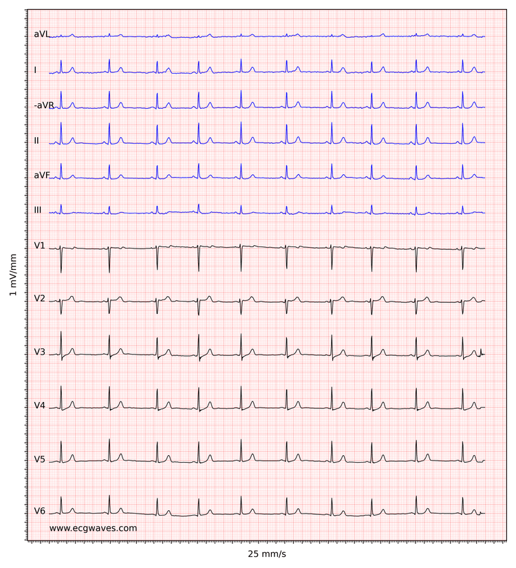 ECG example 3. Normal sinus rhythm. 