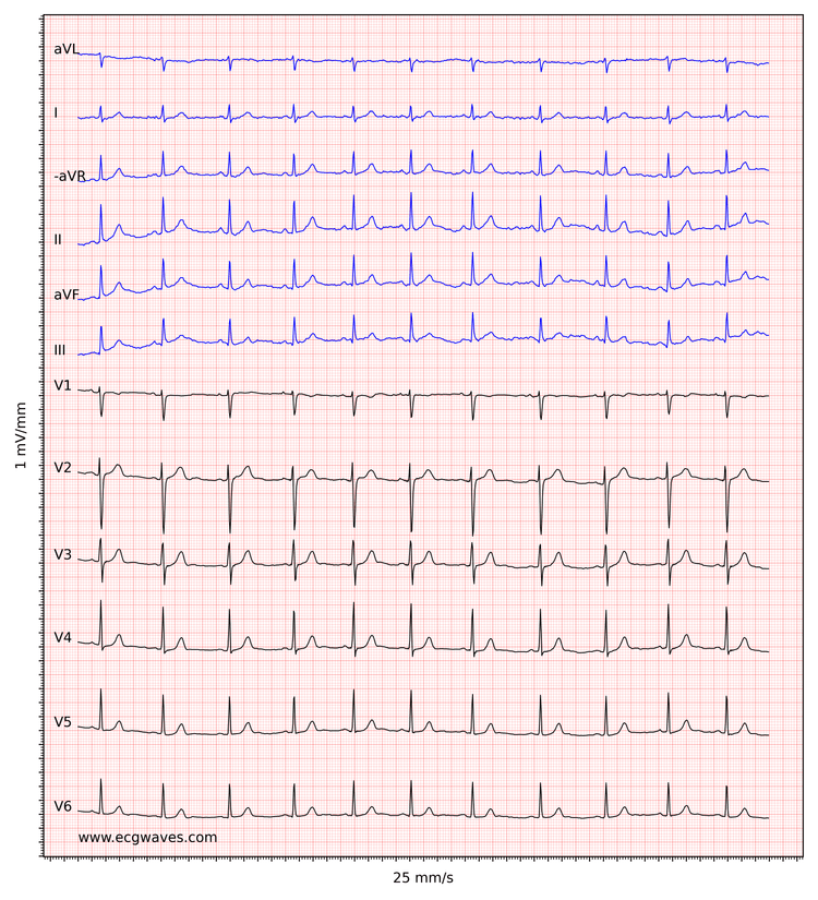 ECG example 4. Normal sinus rhythm. 