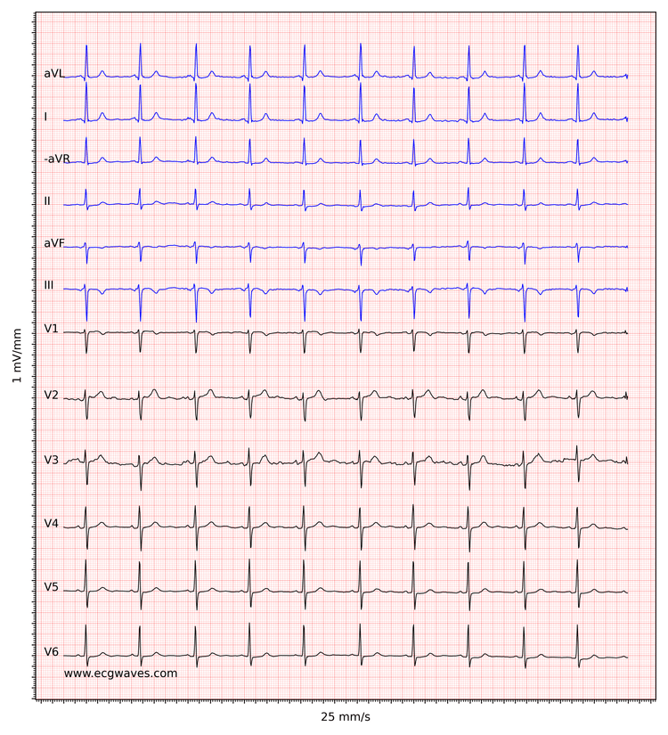 ECG example 5. Sinus rhythm. Negative T-waves in leads aVF and III. Discrete ST-segment depressions in leads V5-V6.