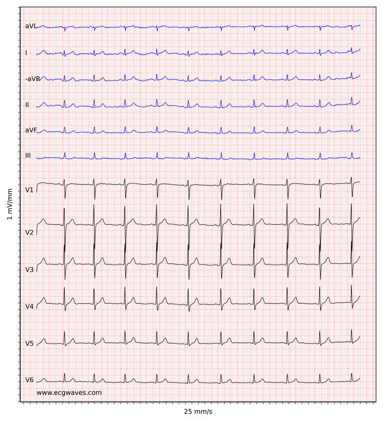 ECG example 6. Sinus rhythm, rapid progression of R-waves in precordial leads. Slight ST-segment elevation in leads V2-V3, which is normal in men and women.