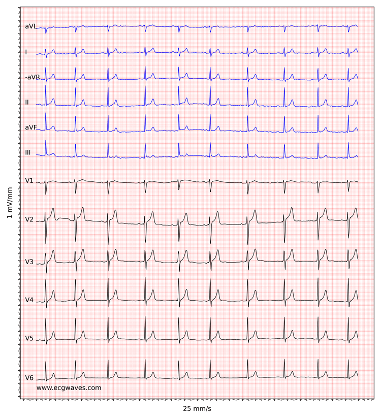 ECG example 7. Sinus rhythm.  Relatively large T-waves in V2-V3, with ST-segment elevations. Relative to the R-waves, T-waves are too large and pointed (differential diagnoses are considered below).
