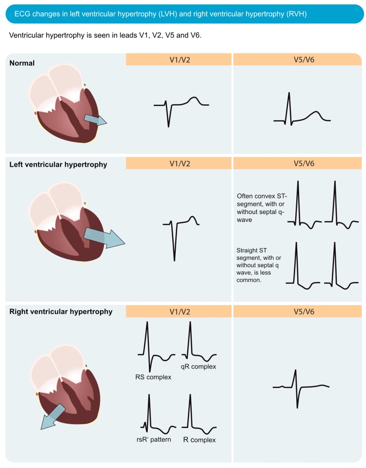 Figure 1. ECG changes seen in left ventricular hypertrophy (LVH) and right ventricular hypertrophy (RVH). The electrical vector of the left ventricle is enhanced in LVH, which results in large R-waves in left-sided leads (V5, V6, aVL and I) and deep S-waves in right-sided chest leads (V1, V2). Right ventricular hypertrophy causes large R-waves in right-sided chest leads and deeper S-waves in left-sided leads.