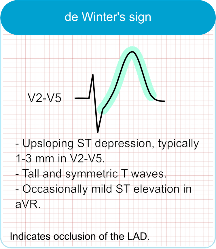 De Winter T-waves (De Winter sign)
