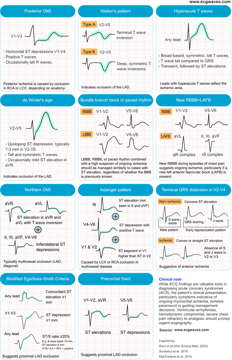 Figure 1. ECG patterns suggestive of acute coronary occlusion (ACO).