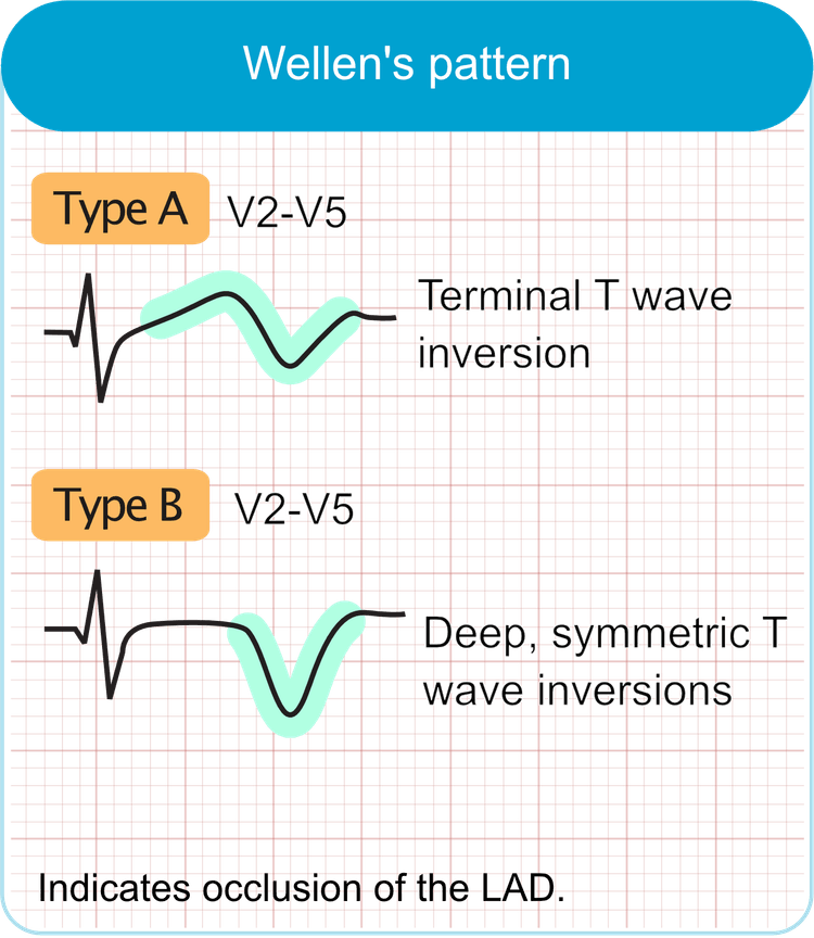 Wellens Syndrome (Wellens ECG pattern)