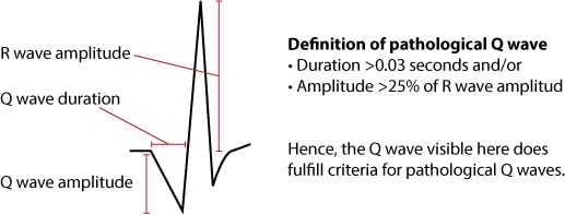 Figure 11. Criteria for pathological Q-waves.
