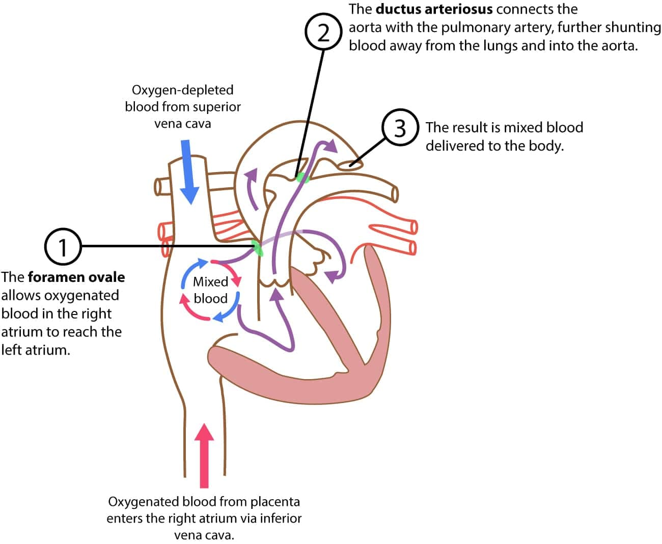 Illustration ur kursen Pediatric and Neonatal ECG Interpretation