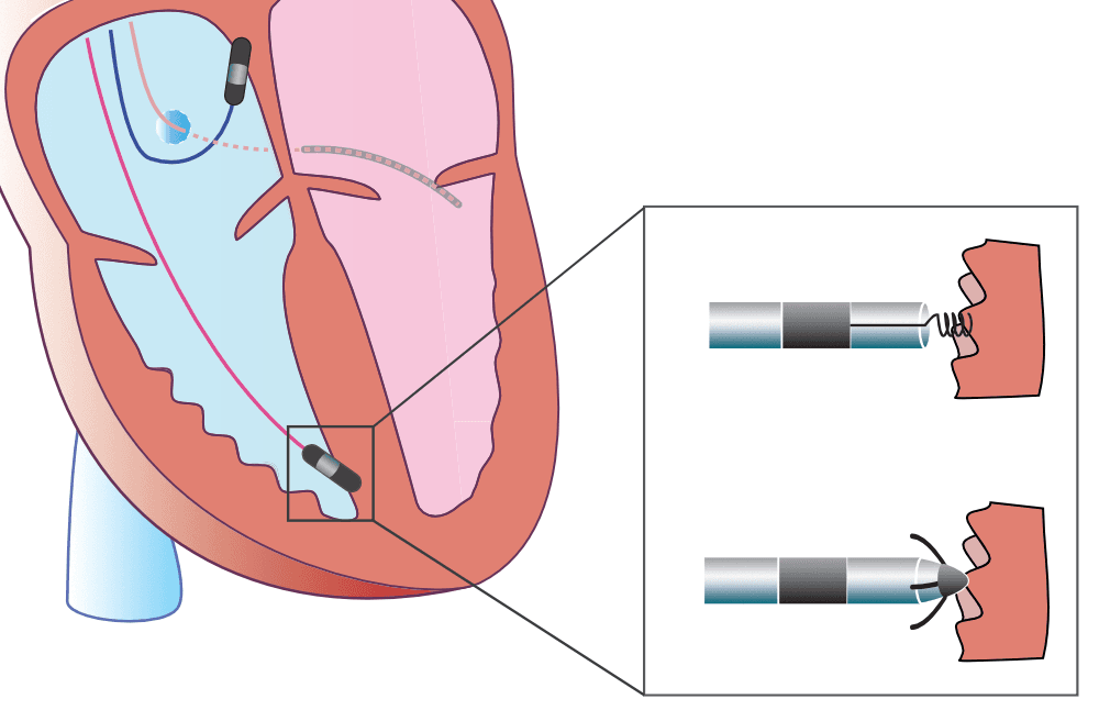 Illustration ur kursen Pacemakers and Cardiac Devices