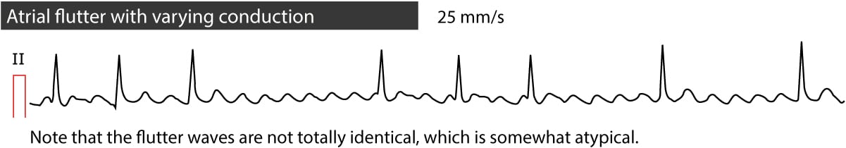 Atrial flutter: classification, causes, ECG criteria and management ...