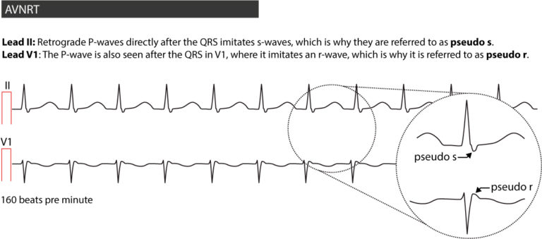 Atrioventricular nodal reentry tachycardia (AVNRT): ECG features ...