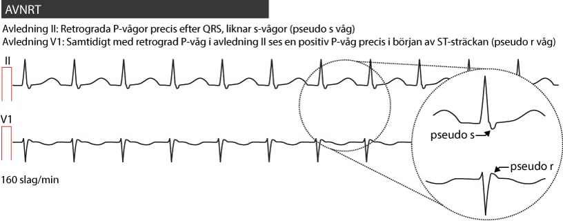 AVNRT_pseudo_s_r – ECG learning