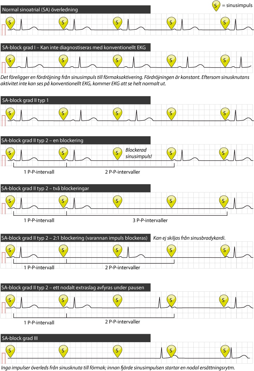 SA_block ECG learning