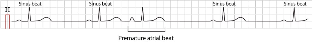 Figure 1. Typical premature atrial contraction (beat/complex).