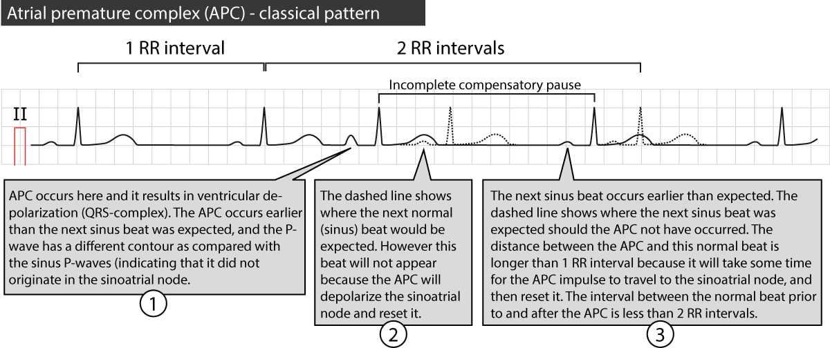 Figure 2. Premature atrial beat with compensatory pause