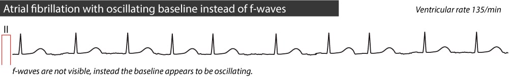 Figure 2. Atrial fibrillation without visible f-waves. Instead there is minute oscillations of the baseline.